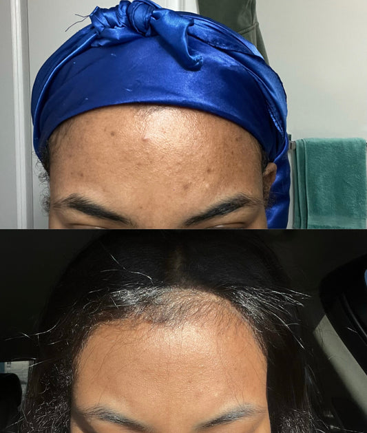 See Her Hyperpigmentation Transformation!